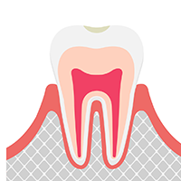 初期むし歯