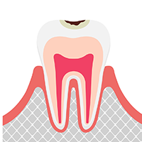 エナメル質のむし歯