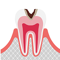 象牙質まで進んだむし歯