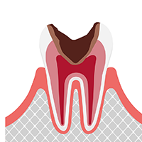 神経まで進んだむし歯