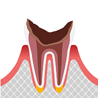 歯根だけ残ったむし歯