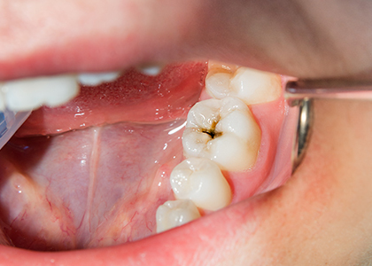 初期のむし歯は自覚症状があることが稀です
