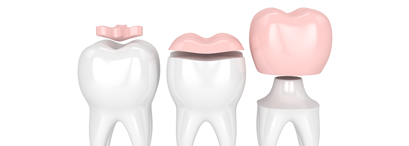歯の詰め物・被せ物