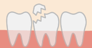 歯の破折