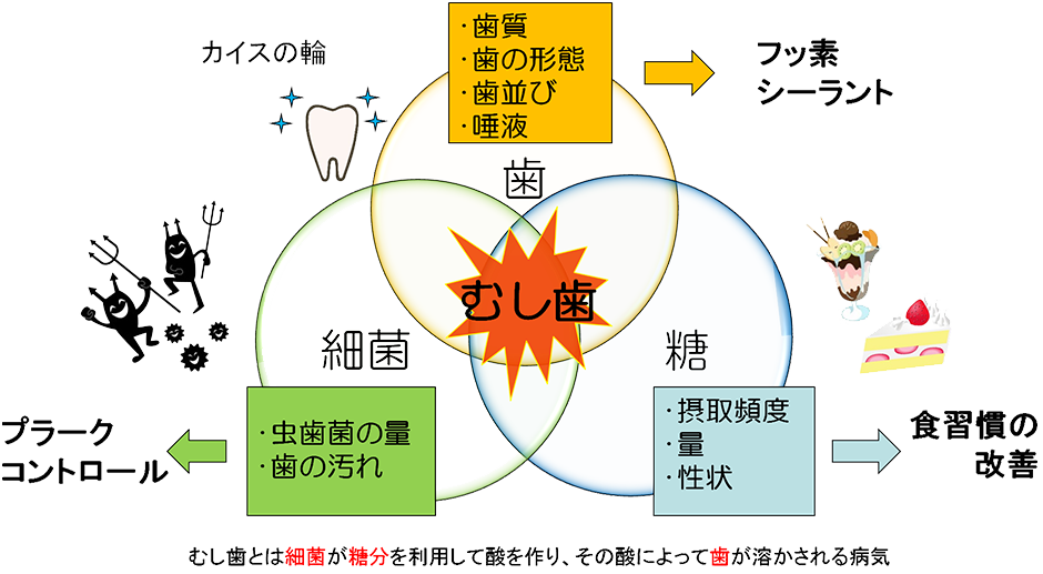 むし歯のメカニズム